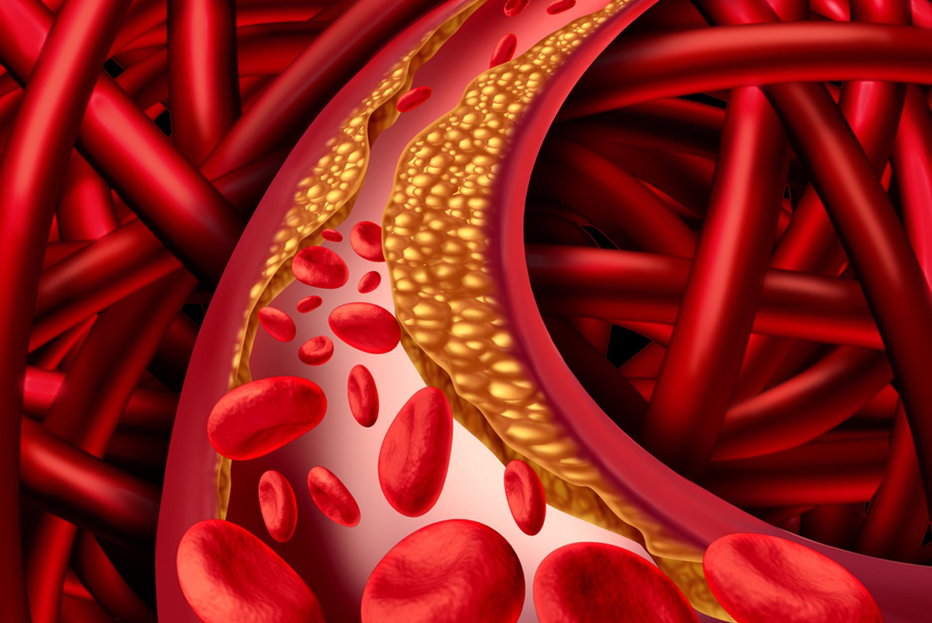 RA Abril 2016 - Salud - Vivir Mejor - Arterioesclerosis